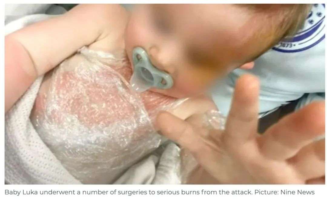 身份确认！是中国留学生向澳9个月大婴儿泼滚烫咖啡致其严重烫伤！现已被全球通缉！最高可判终身监禁！