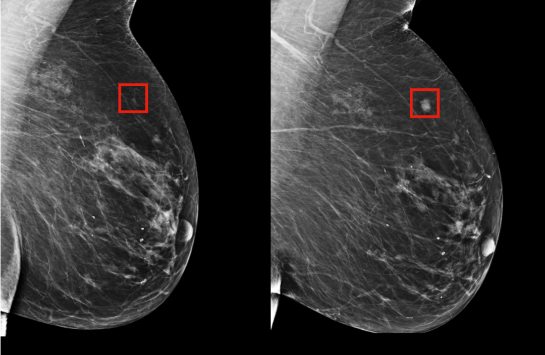 MIT CSAIL's AI can predict the onset of breast cancer 5 years in advance |  VentureBeat