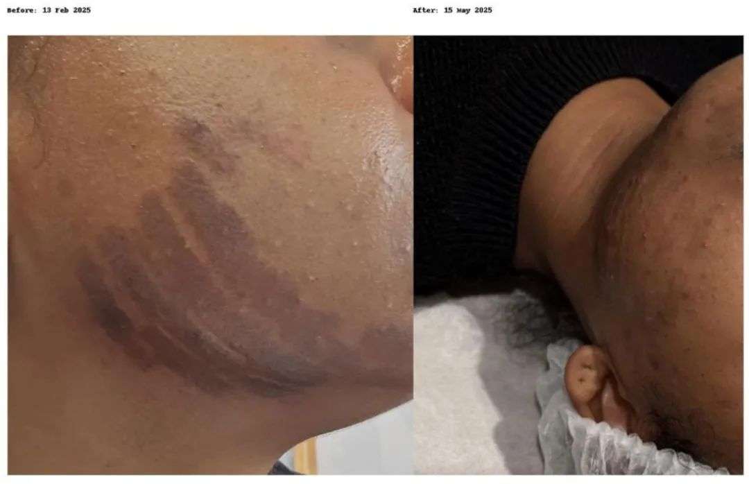 On the left, Shirley Agostinha de Oliveira's skin soon after the burns and on the right, after receiving follow-up care from the clinic. Photos / Supplied