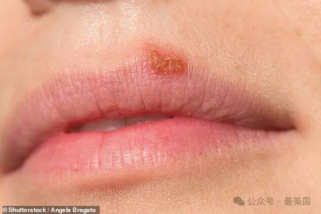 For adults a cold sore, caused by the herpes simplex virus, is not only common but can also 'spontaneously resolve' or be treated with anti-viral creams