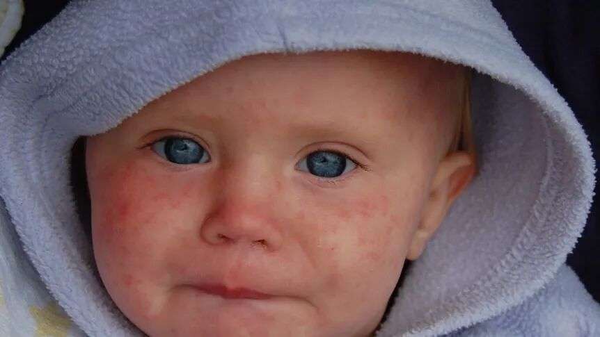 A photo of a child with a measles rash on their face.