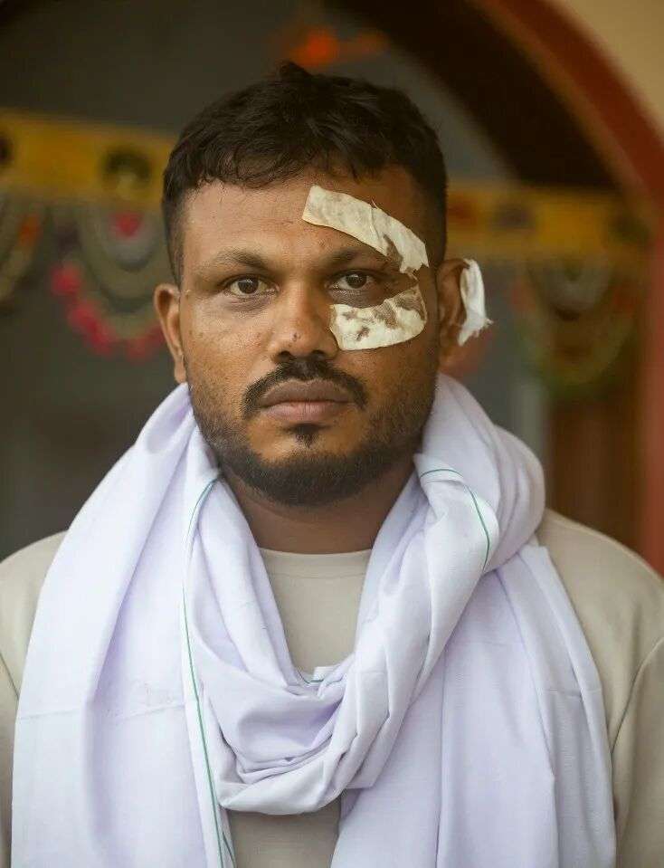 印度航空空难的唯一幸存者，脸上缠着绷带。