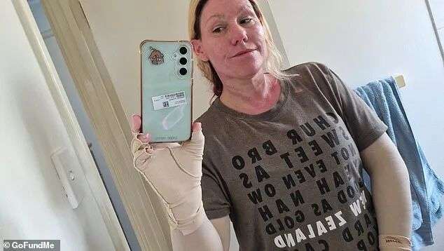 Ms Travers (pictured) says she'll need to wear compression garments for the next year but despite the garments she'll be scarred for life