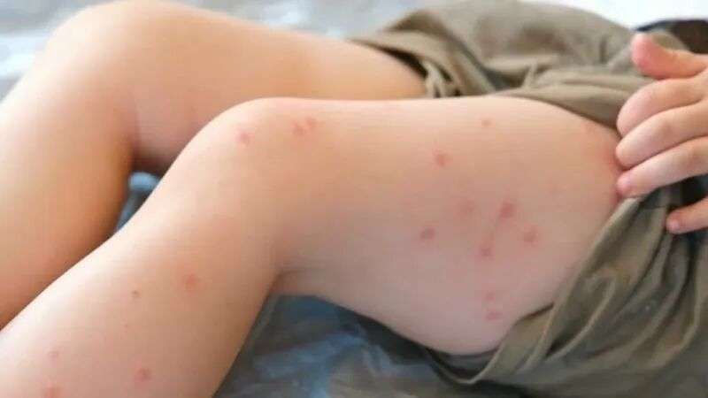 Measles cases spiking across Queensland