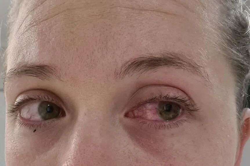 Close up of a woman's face, with a bloodshot eye.