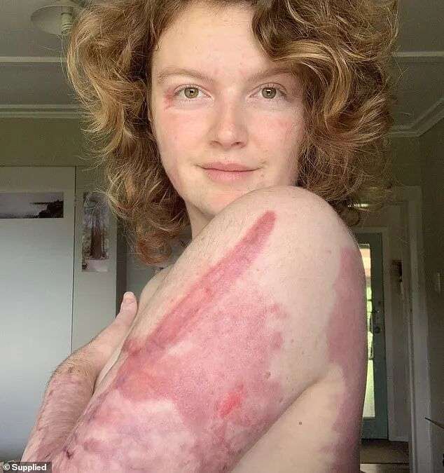 Kelsey Waghorn was a 25-year-old tour guide and one of 47 people on New Zealand's White Island when it erupted on December 9, 2019. She has written a book about that day and its aftermath. She is pictured IN April 2020 showing some of her injuries