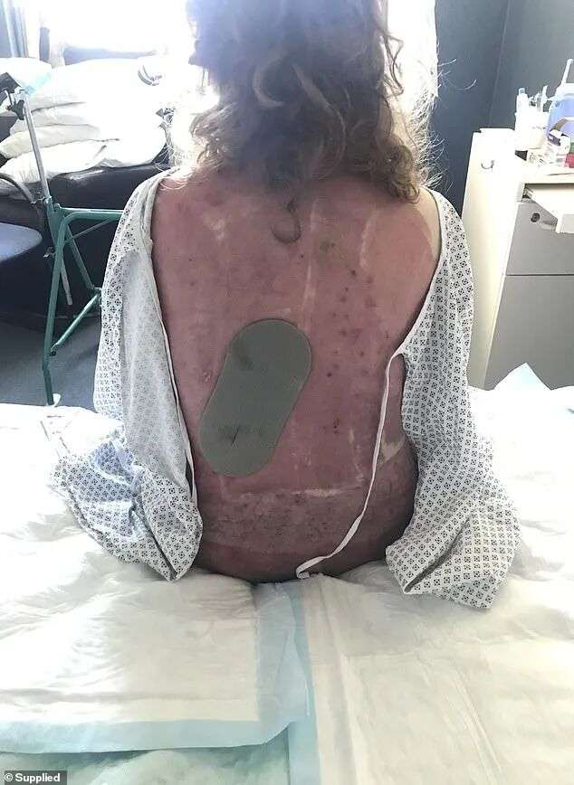 'Fear had filled my body as soon as I saw that ashen cloud barrelling down the island,' Waghorn writes. She is pictured recovering from her injuries, including severe burns to her back