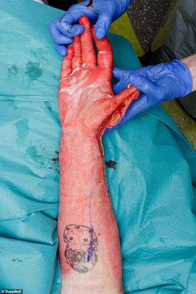 'My exposed arms started to feel like they were on fire,' Kesley Waghorn writes in Surviving White Island.&nbsp; A section of her right elbow (above) escaped damage because she kept her hands over her face as long as she could