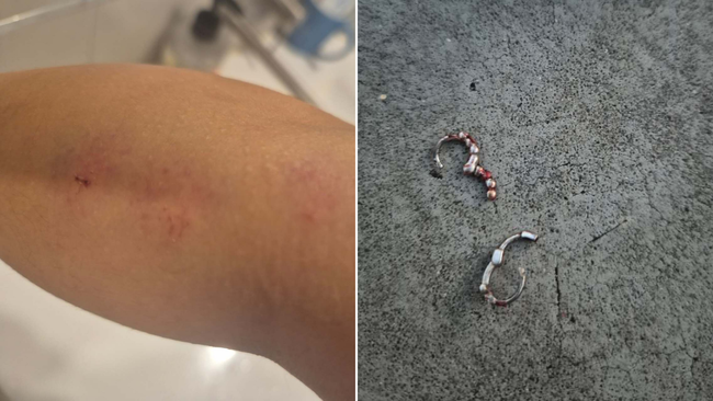 她双臂布满淤青,耳环上也沾满了血迹。